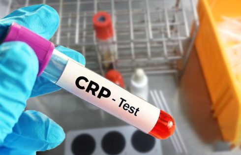 An Overview of What is CRP Test All About?