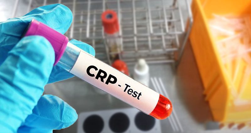 An Overview of What is CRP Test All About?